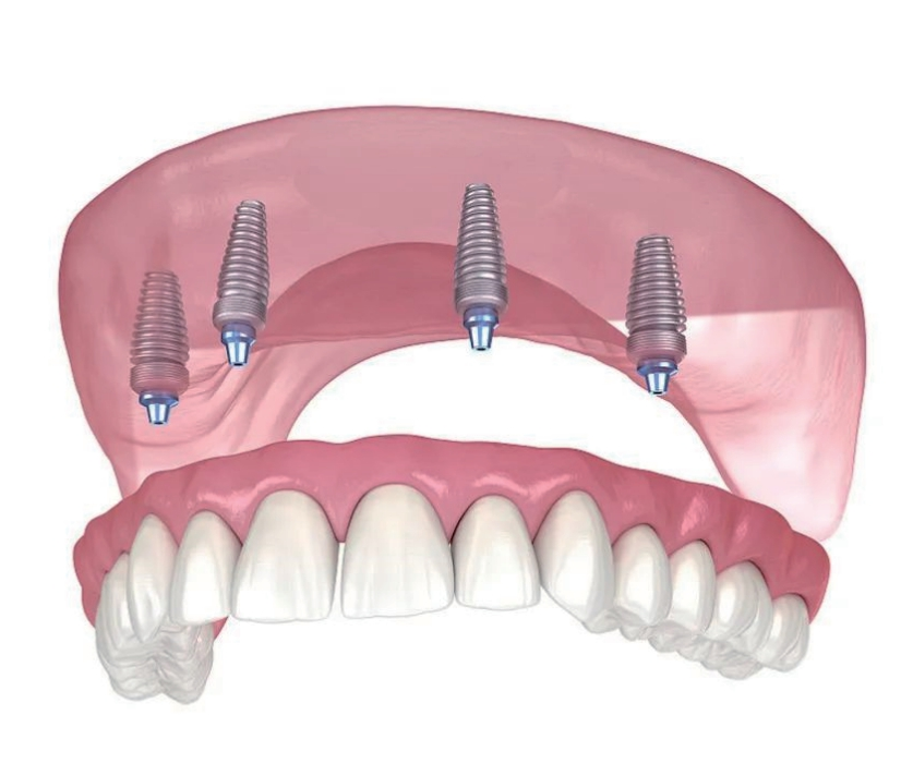 种植活动修复ALL-ON-FOUR